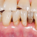 periodontal disease screening