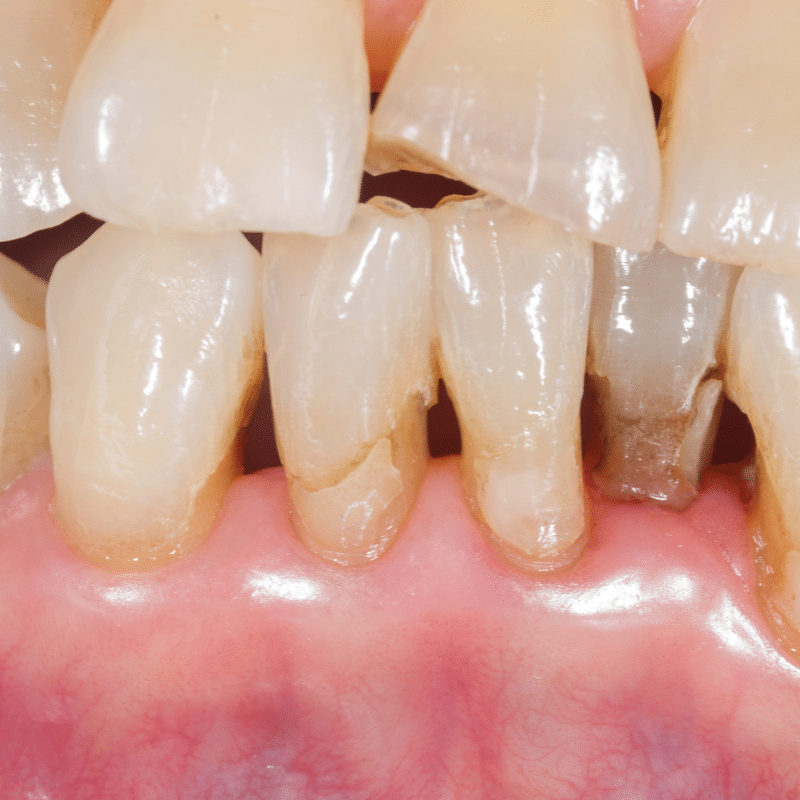 periodontal diseases screening