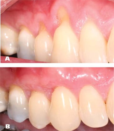 periodontal disease screening gum recession