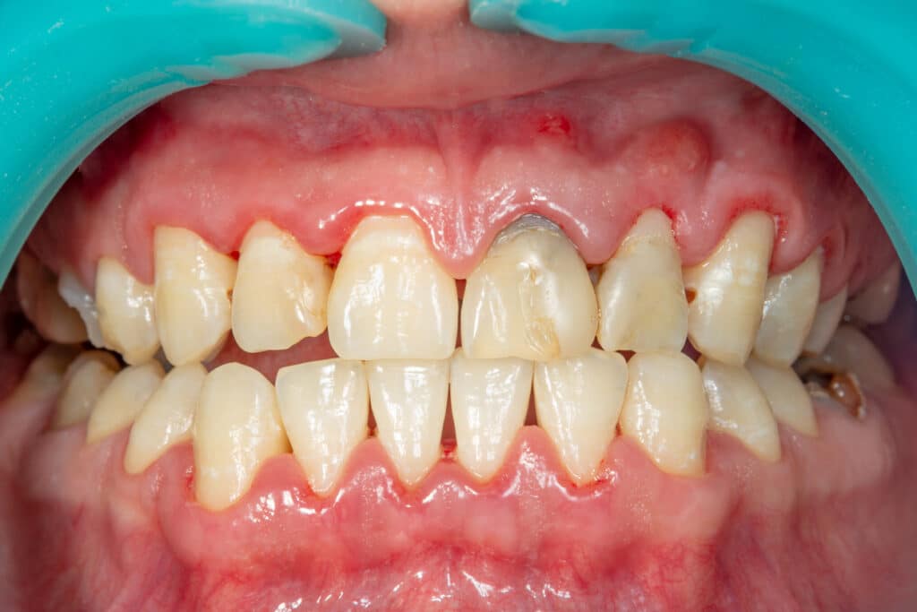 Close up of dry mouth. Dentistry treatment of dental plaque by Tacoma dentist
