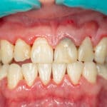 Dentistry treatment of dental plaque by Tacoma dentist