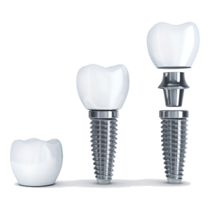 Dental Implants by Tacoma dentist at Soundview Dental Arts