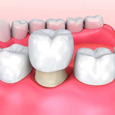 Dental Crowns by Tacoma dentist at Soundview Dental Arts