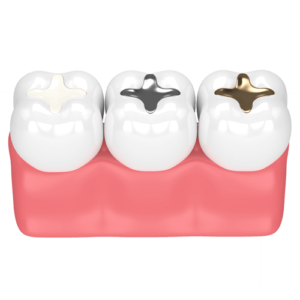 Dental Fillings by Tacoma dentist at Soundview Dental Arts