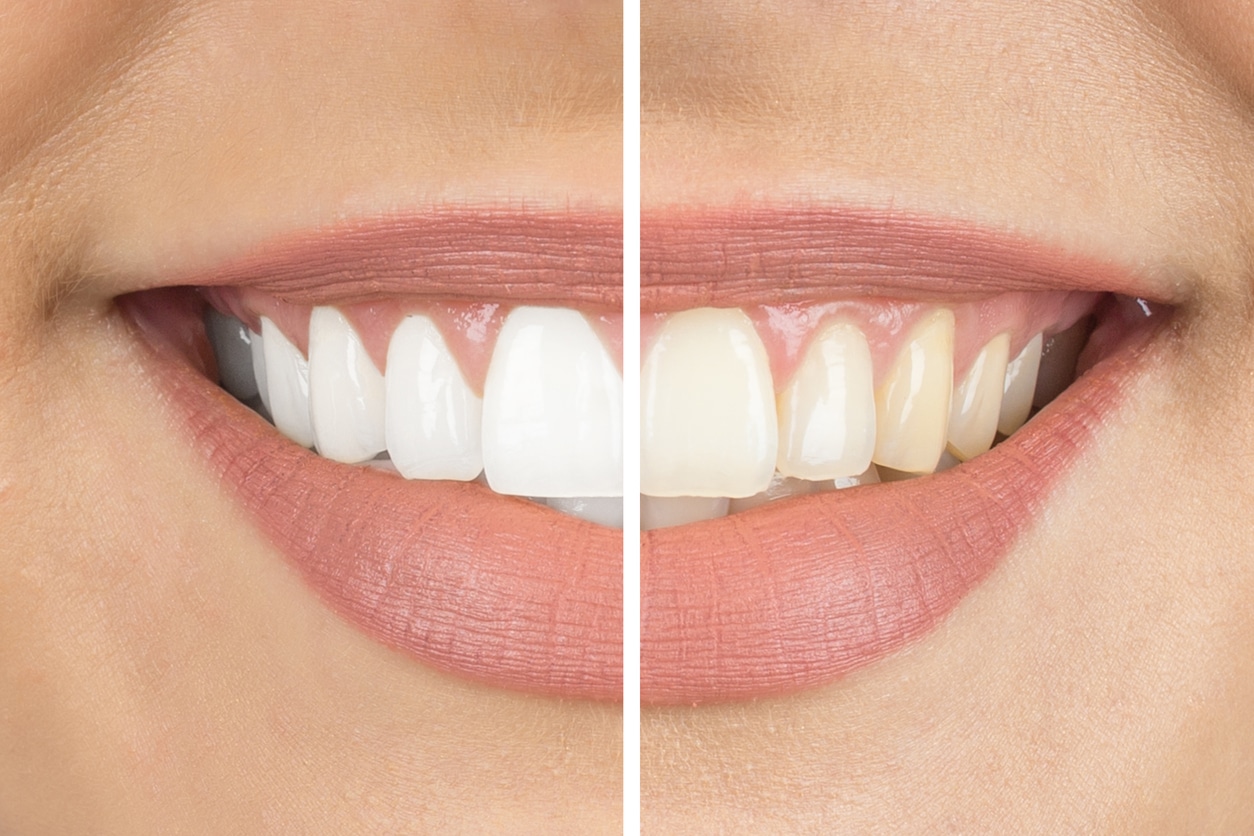 Before and after teeth whitening by Tacoma dentist at Soundview Dental Arts