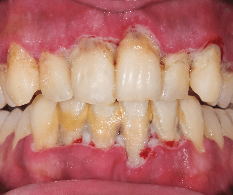 periodontal diseases - Fluoride Treatment